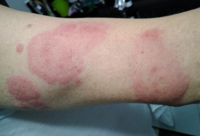 Allergic skin reaction arm